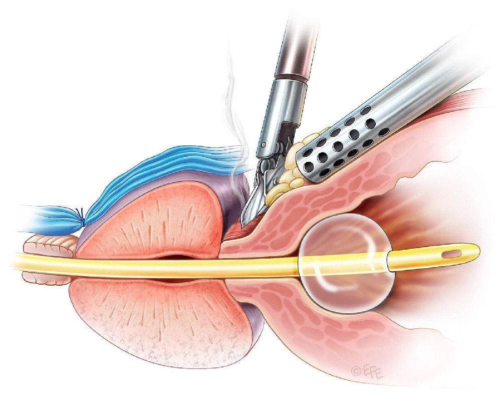 什么是前列腺肿瘤腹腔镜切除手术