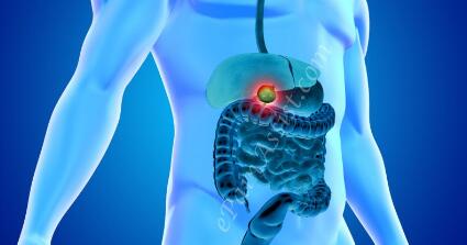 怎么预防胆囊癌?